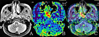 Tumor Blood Flow Is a Predictor of Radiotherapy Response in Patients With Nasopharyngeal Carcinoma